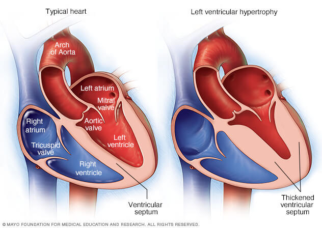 Hipertrofia ventricular